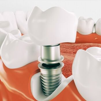 Implantes Dentales clinica dental Salamanca